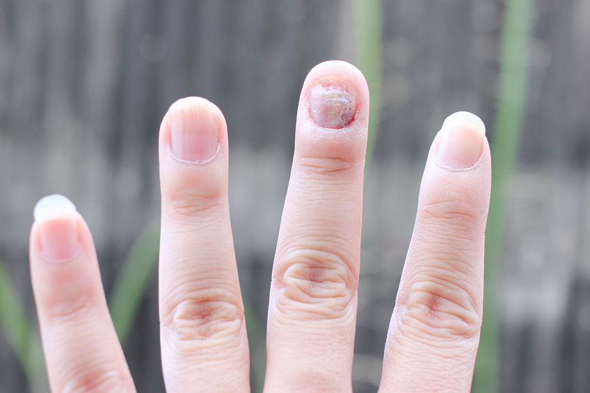 gyors kezelés a gomba kéz körmök nail gombák new receptek